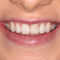 Composite Veneers - Smile 5 before